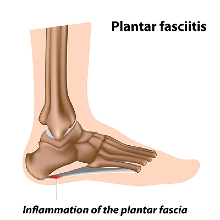 Foot pain inside 2025 arch near heel