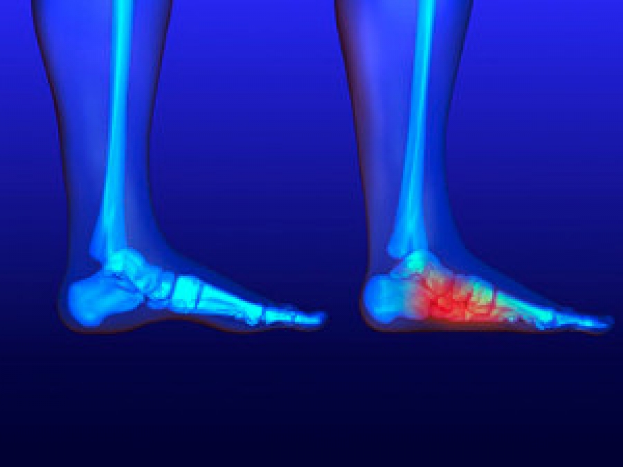 Flexible Flatfoot - Foot Health Facts