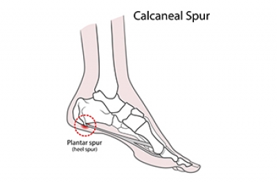 Best Shoes for Bone Spurs: A Comprehensive Guide